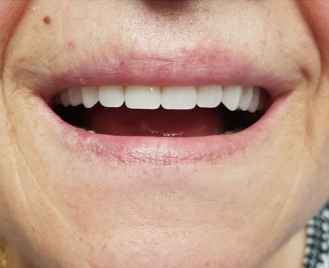 Le sourire uniforme et d&rsquo;apparence naturelle de la même patiente après de nouvelles prothèses complètes