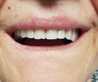 Gros plan des dents usées et inégales d&rsquo;une patiente avant des prothèses complètes