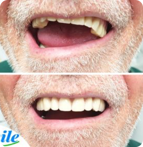 Résultat de prothèse avant-après réalisé chez Smile Denture Ottawa