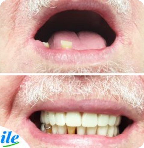 Résultat de prothèse avant-après réalisé chez Smile Denture Ottawa
