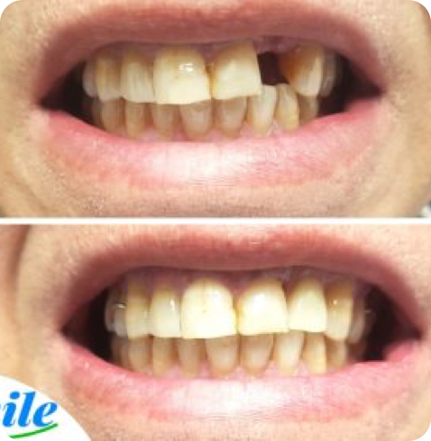 Résultat de prothèse avant-après réalisé chez Smile Denture Ottawa