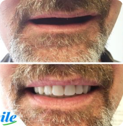 Résultat de prothèse avant-après réalisé chez Smile Denture Ottawa