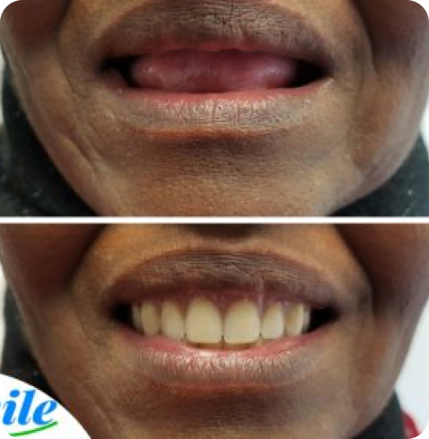 Résultat de prothèse avant-après réalisé chez Smile Denture Ottawa