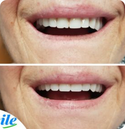 Résultat de prothèse avant-après réalisé chez Smile Denture Ottawa