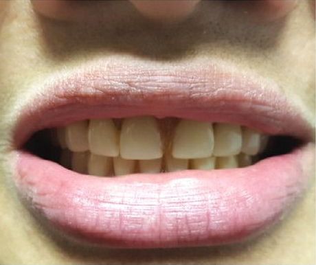 Une prothèse fissurée dans la bouche d&rsquo;une patiente avant réparation