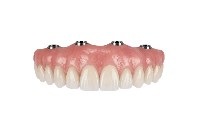 Une prothèse sur implants avec attaches à pression