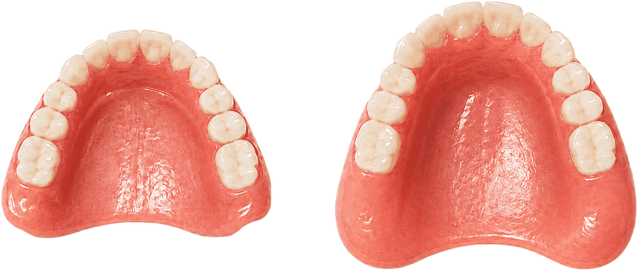 Regarnissages et rebasages — deux prothèses complètes réajustées pour restaurer une tenue confortable et bien ajustée